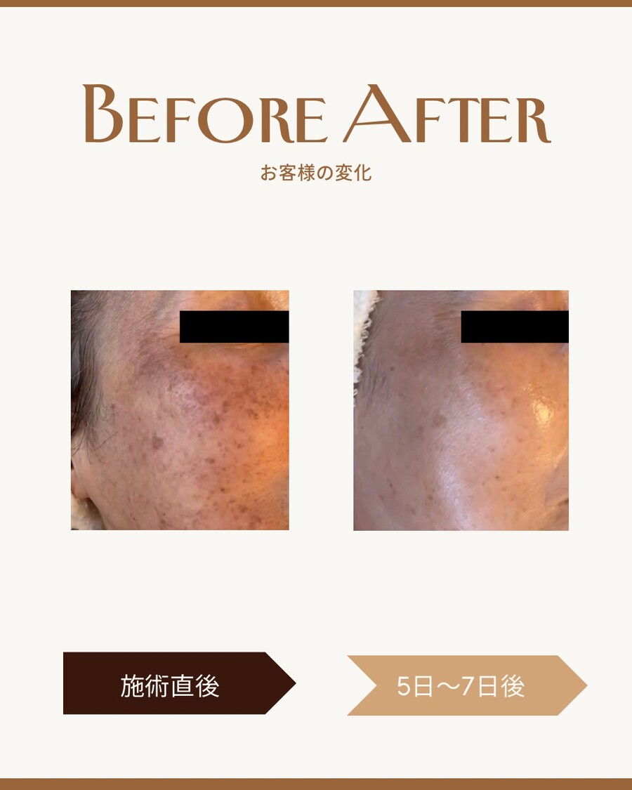 フォトフェイシャル施術前後のお客様の変化